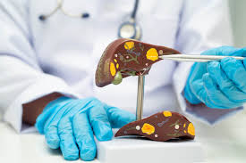 Cancerous Liver